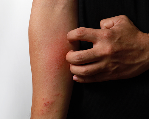 Man scratching red patch of skin